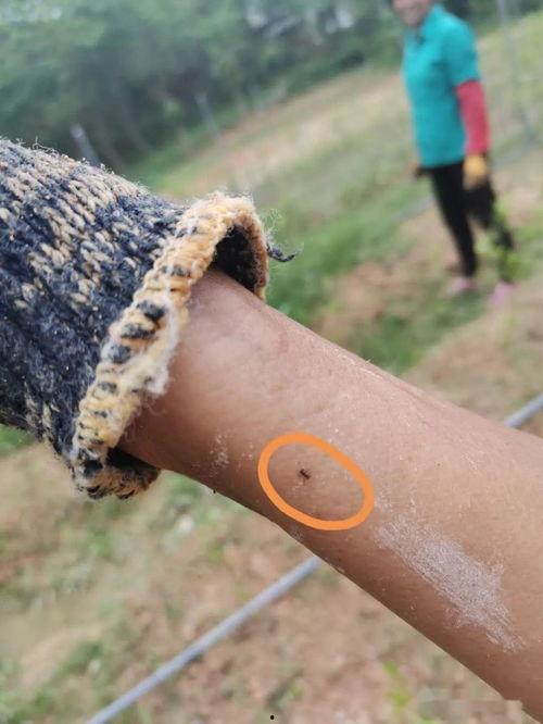 脓包视频,视频揭示皮肤感染真相