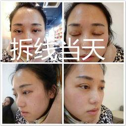 双眼皮去脂视频,美丽蜕变背后的秘密